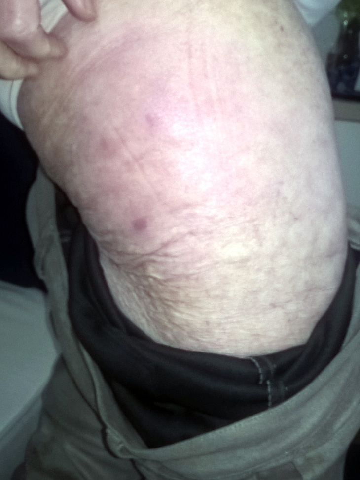 bahandeling hardnekkige bloeduitstorting